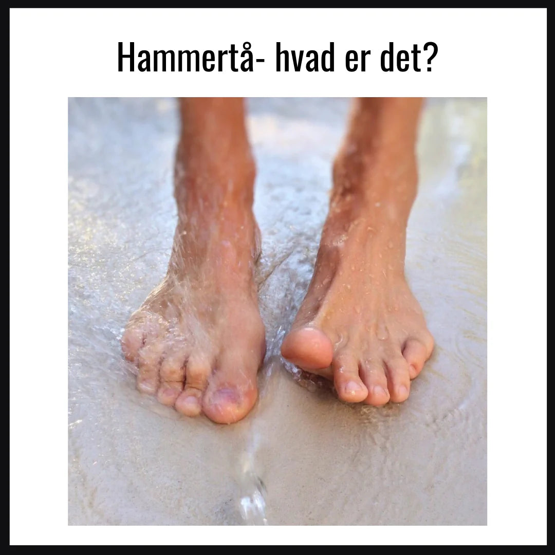 Hammertå- hvad er det?